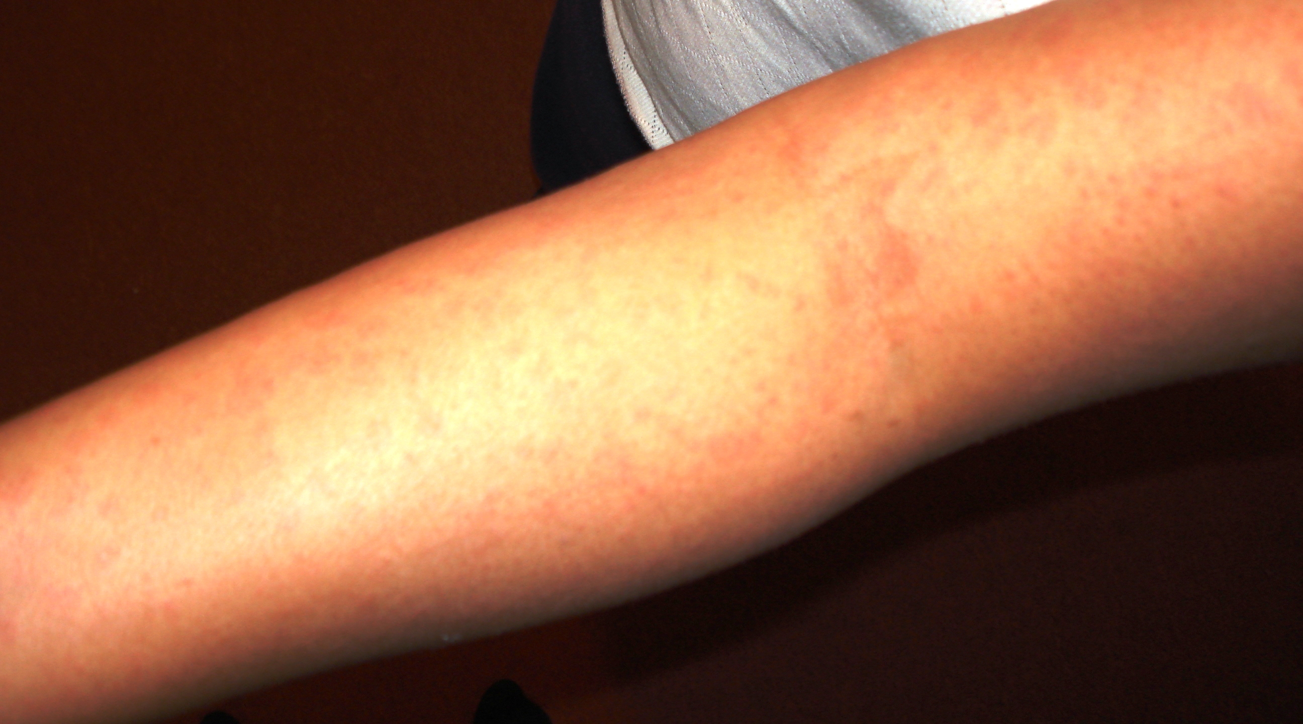 Vaginal Rash From Cipro
